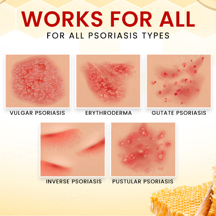 ⚡ New Year Flash Deals! 50% OFF - RZXEA™ Bee Venom Psoriasis Treatment Cream