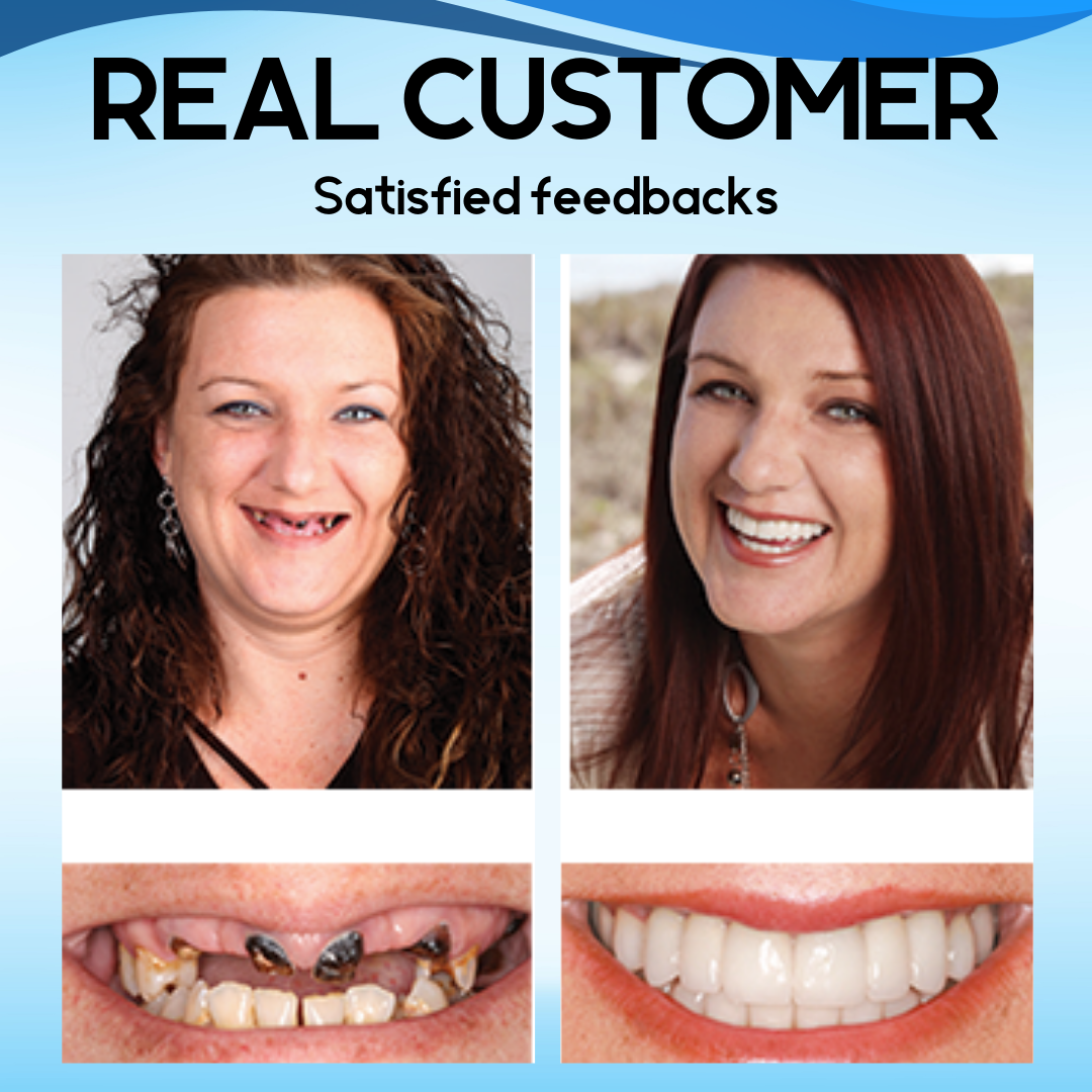 Bikenda® Silicone Snap On Veneers