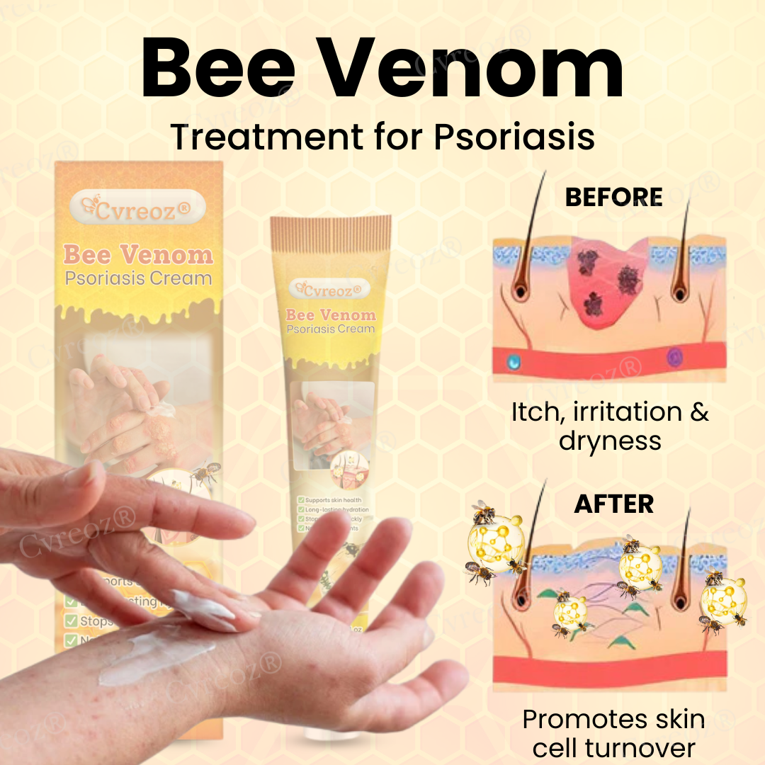 Cvreoz® Bee Venom Psoriasis Cream